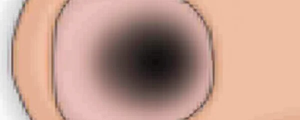 black-spot-on-a-nail-what-it-means